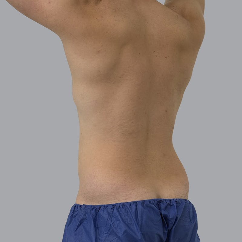 Body Liposuction Before & After Gallery - Patient 146369 - Image 3