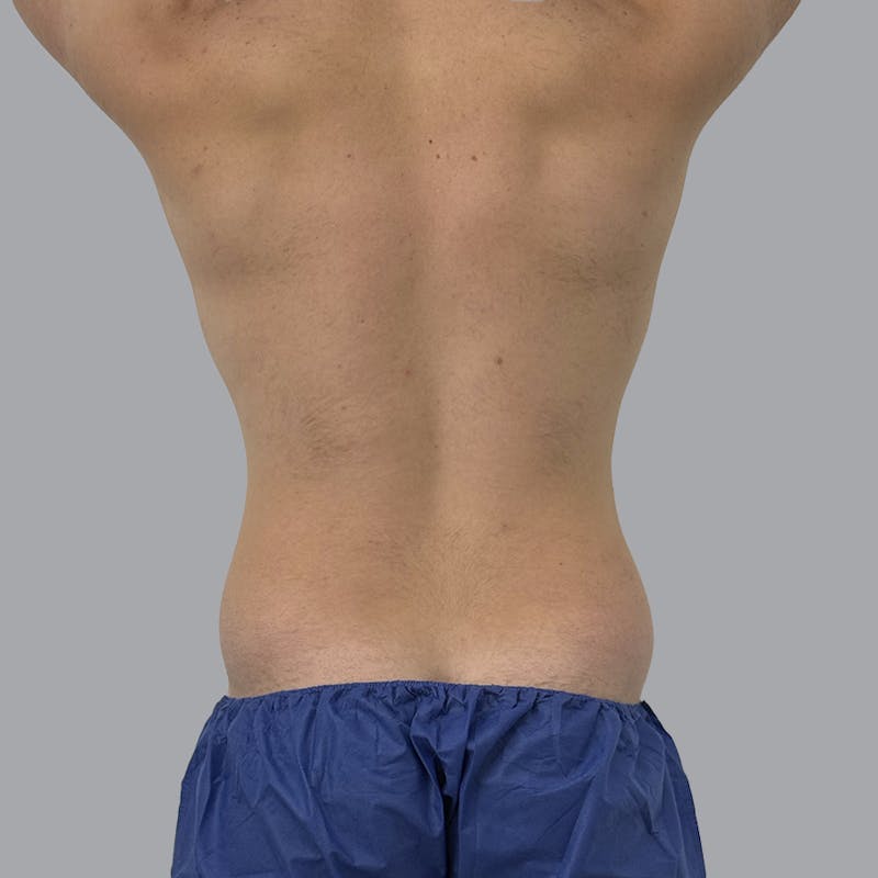 Body Liposuction Before & After Gallery - Patient 146369 - Image 1
