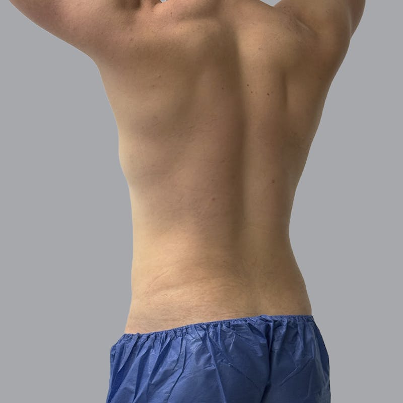 Body Liposuction Before & After Gallery - Patient 146369 - Image 4