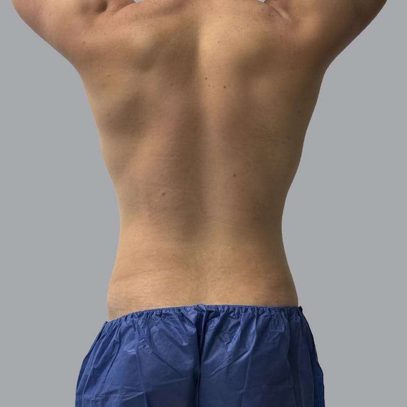 Body Liposuction Before & After Gallery - Patient 146369 - Image 2