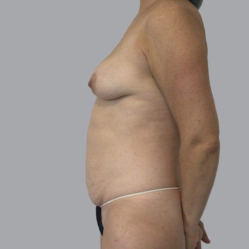 Mommy Makeover Before & After Gallery - Patient 426886 - Image 5