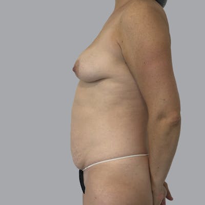 Mommy Makeover Before & After Gallery - Patient 426886 - Image 5