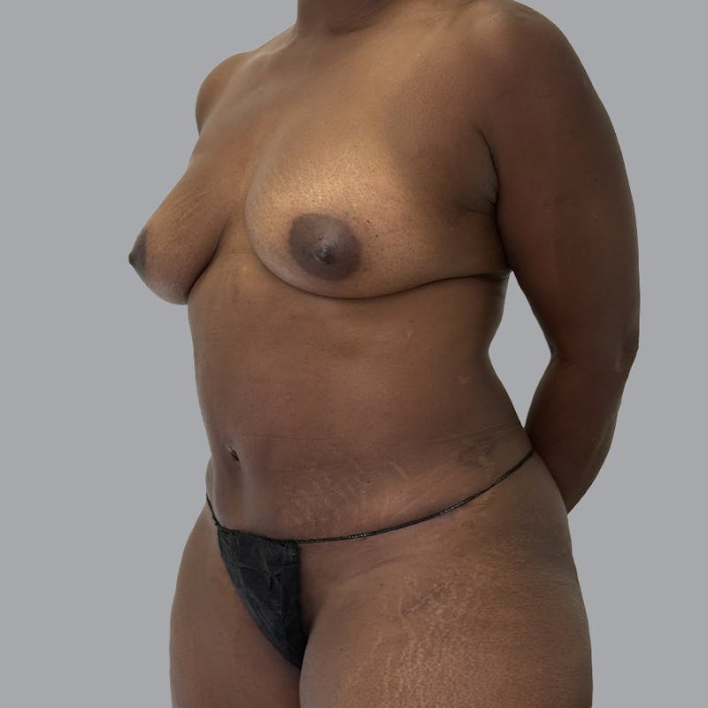 Mommy Makeover Before & After Gallery - Patient 195078 - Image 4