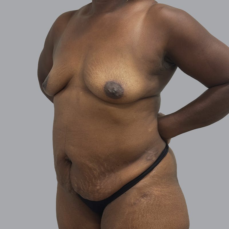 Mommy Makeover Before & After Gallery - Patient 195078 - Image 3