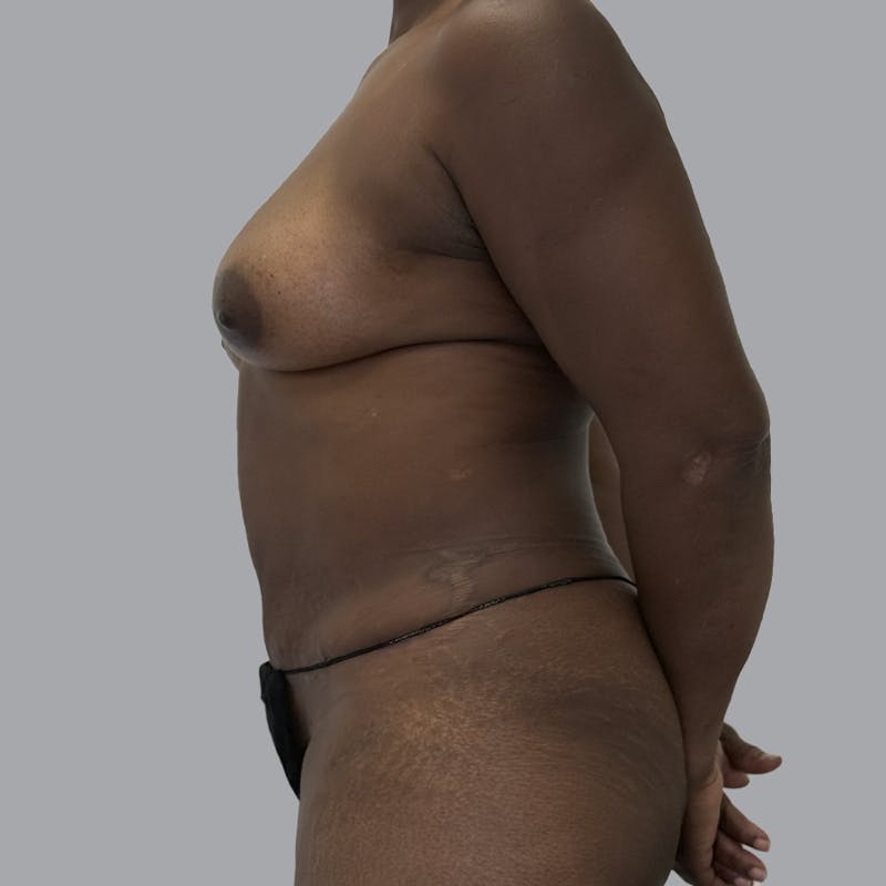 Mommy Makeover Before & After Gallery - Patient 195078 - Image 6