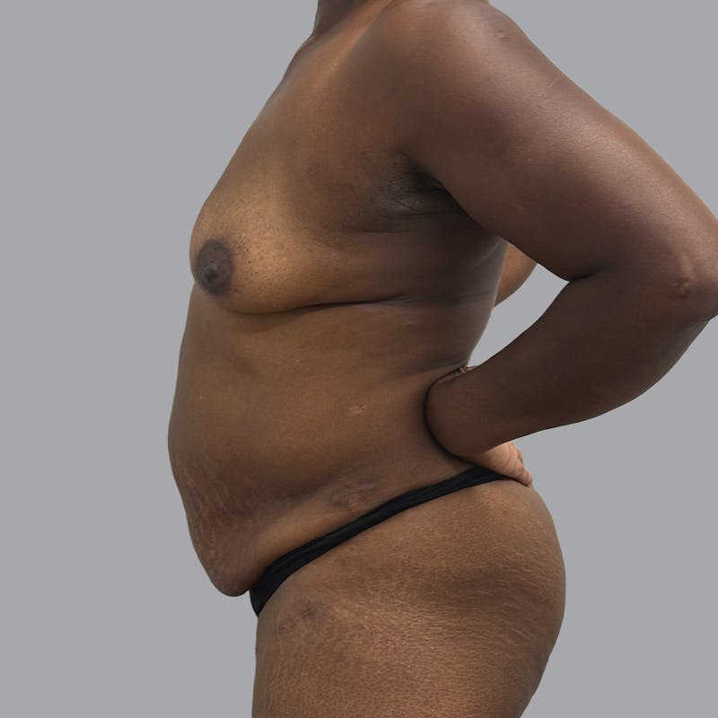 Mommy Makeover Before & After Gallery - Patient 195078 - Image 5