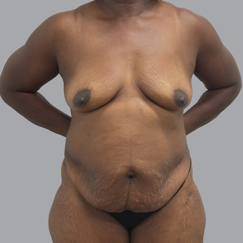 Mommy Makeover Before & After Gallery - Patient 195078 - Image 1