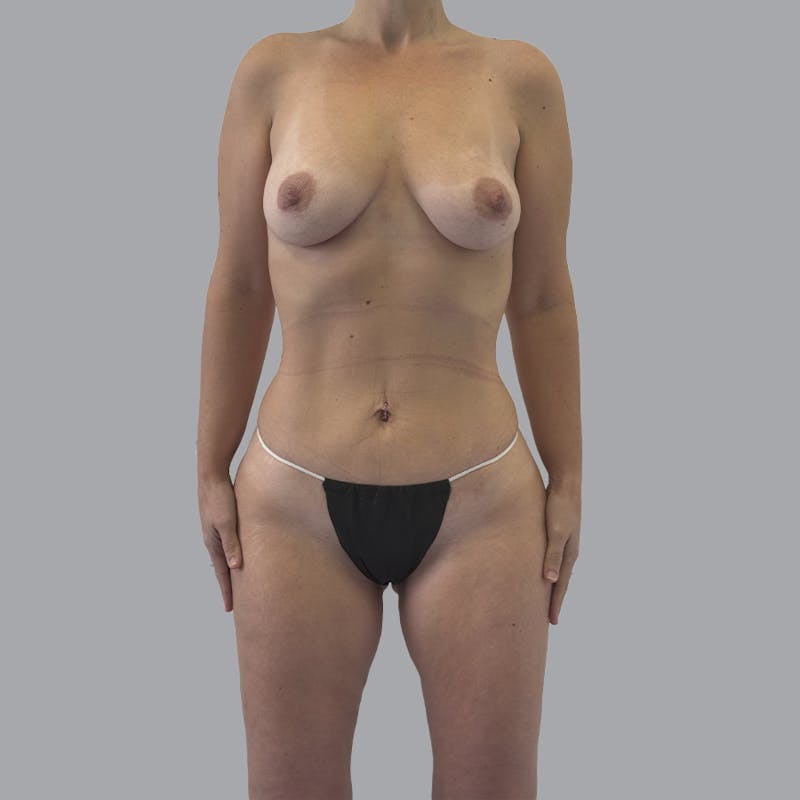 Mommy Makeover Before & After Gallery - Patient 392272 - Image 2