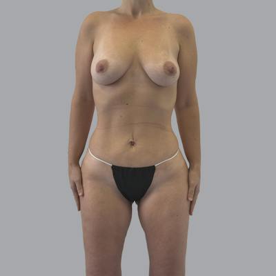 Mommy Makeover Before & After Gallery - Patient 392272 - Image 2