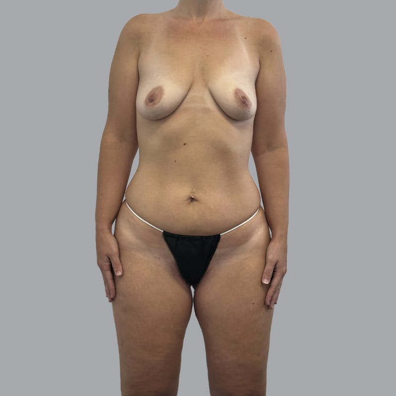 Mommy Makeover Before & After Gallery - Patient 392272 - Image 1