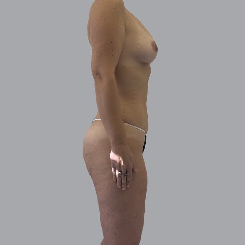 Mommy Makeover Before & After Gallery - Patient 392272 - Image 6
