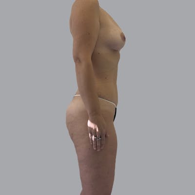 Mommy Makeover Before & After Gallery - Patient 392272 - Image 6