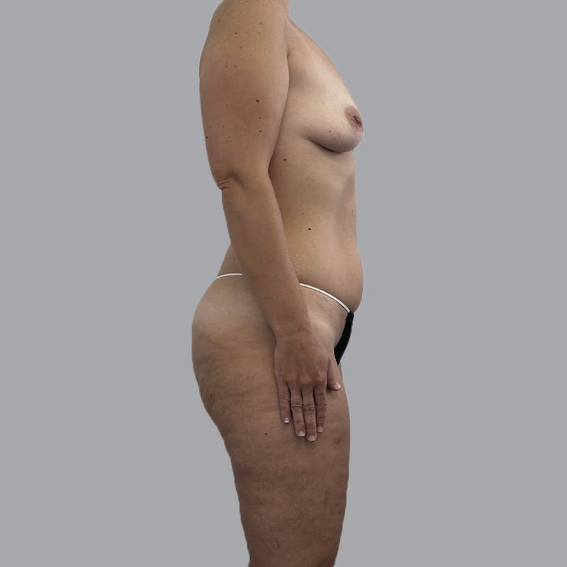 Mommy Makeover Before & After Gallery - Patient 392272 - Image 5