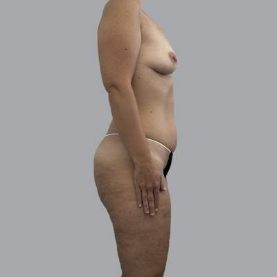 Mommy Makeover Before & After Gallery - Patient 392272 - Image 5