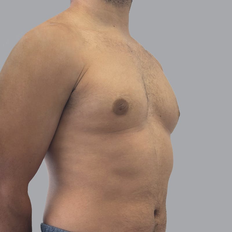 Gynecomastia Before & After Gallery - Patient 156982 - Image 4