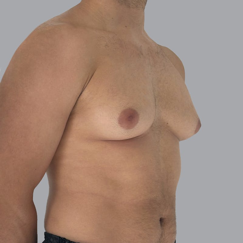 Gynecomastia Before & After Gallery - Patient 156982 - Image 3