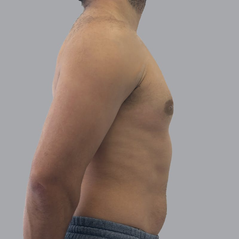 Gynecomastia Before & After Gallery - Patient 156982 - Image 6