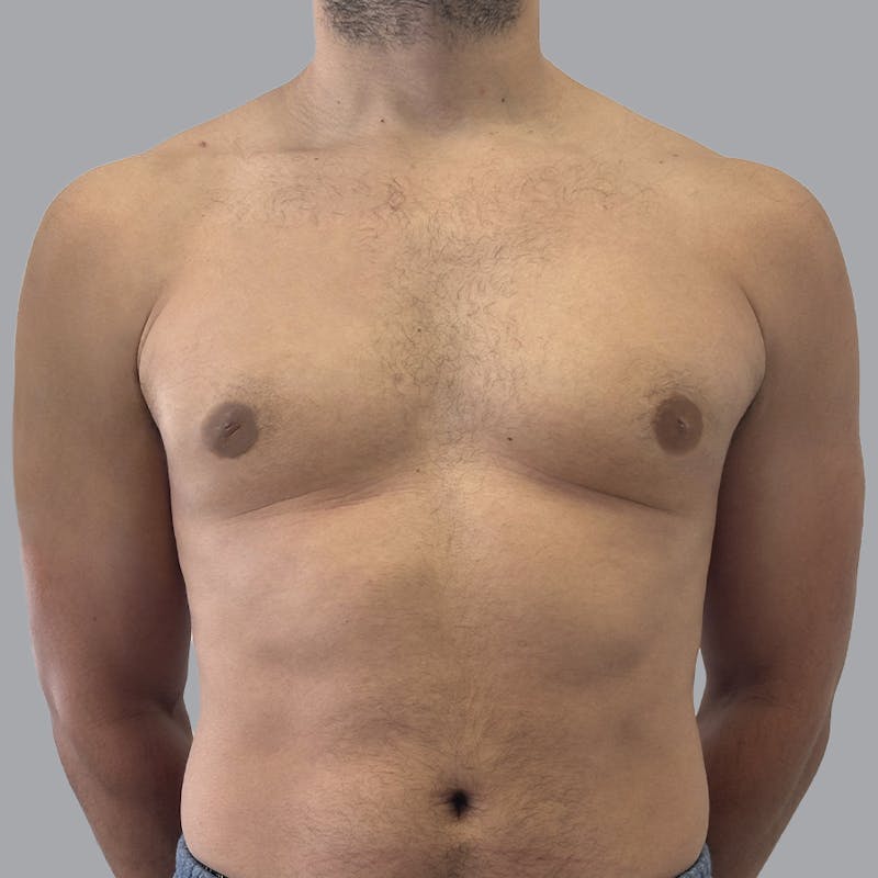 Gynecomastia Before & After Gallery - Patient 156982 - Image 2