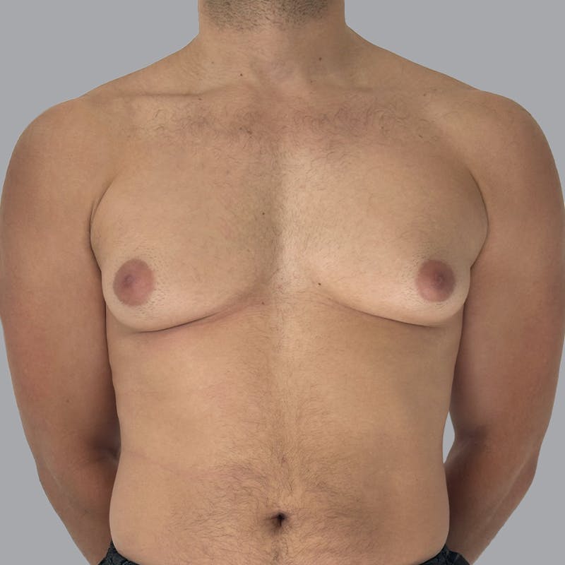 Gynecomastia Before & After Gallery - Patient 156982 - Image 1