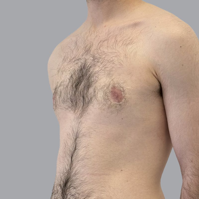 Gynecomastia Before & After Gallery - Patient 753887 - Image 4