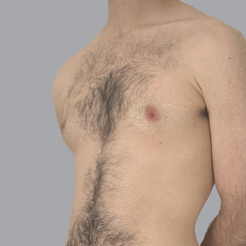 Gynecomastia Before & After Gallery - Patient 753887 - Image 3