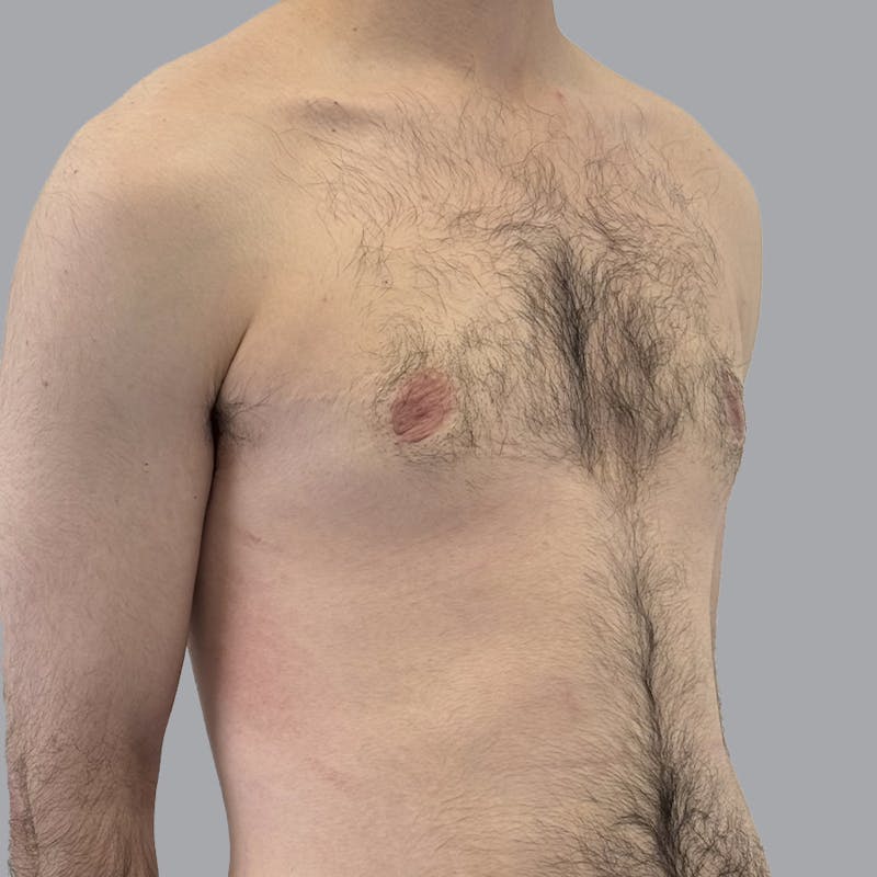 Gynecomastia Before & After Gallery - Patient 753887 - Image 2