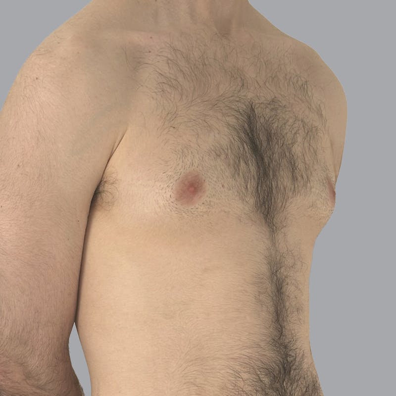 Gynecomastia Before & After Gallery - Patient 753887 - Image 1