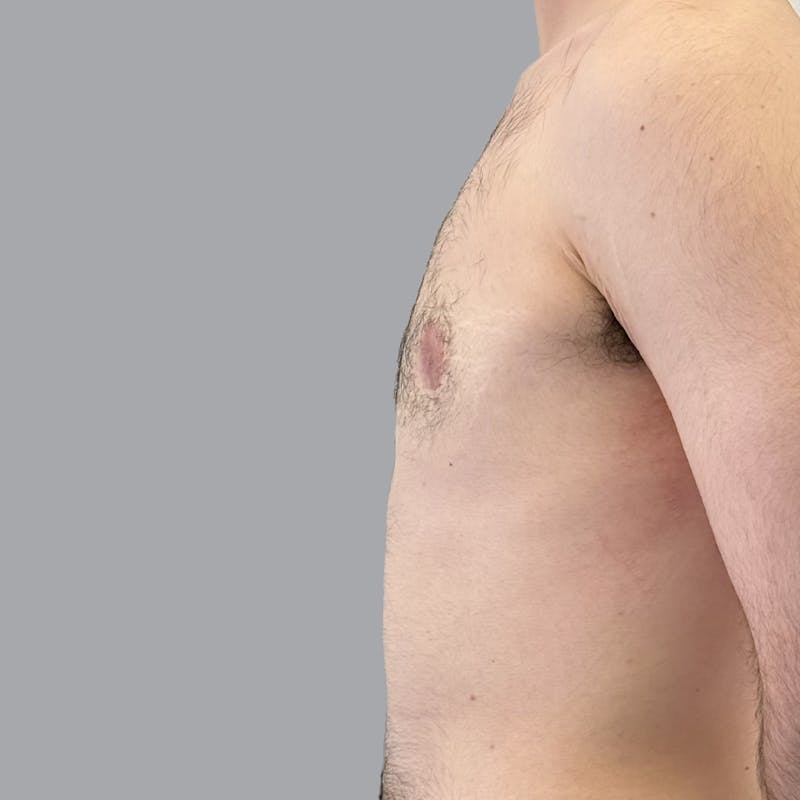 Gynecomastia Before & After Gallery - Patient 753887 - Image 6
