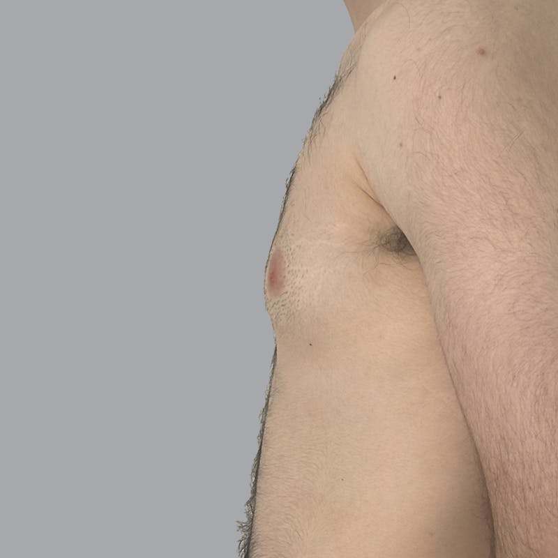 Gynecomastia Before & After Gallery - Patient 753887 - Image 5