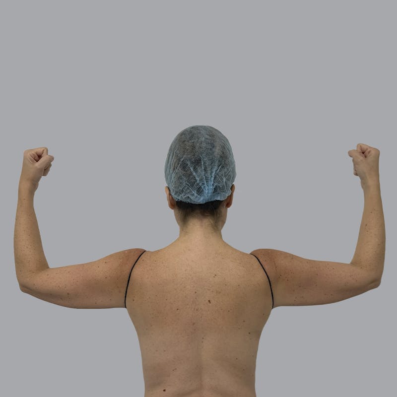 Lipedema Before & After Gallery - Patient 160150 - Image 1