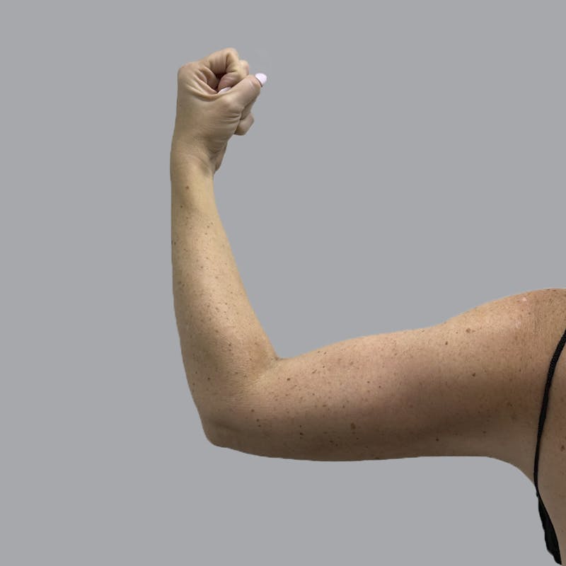 Lipedema Before & After Gallery - Patient 160150 - Image 4