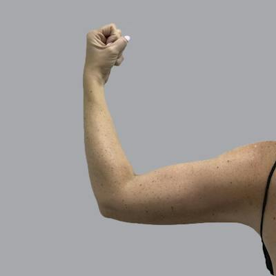 Lipedema Before & After Gallery - Patient 160150 - Image 4
