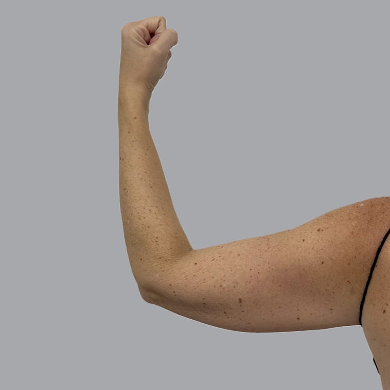 Lipedema Before & After Gallery - Patient 160150 - Image 3