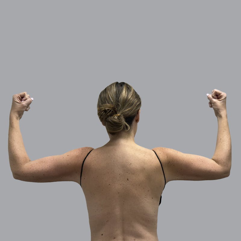 Lipedema Before & After Gallery - Patient 160150 - Image 2