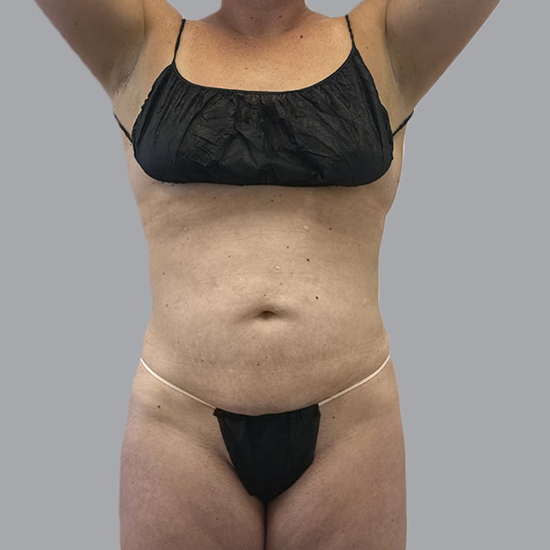 Body Liposuction Before & After Gallery - Patient 217186 - Image 2