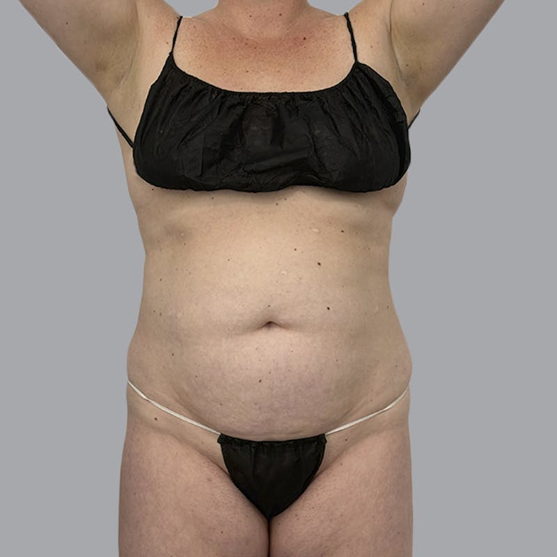 Body Liposuction Before & After Gallery - Patient 217186 - Image 1