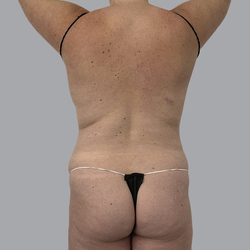 Body Liposuction Before & After Gallery - Patient 217186 - Image 7