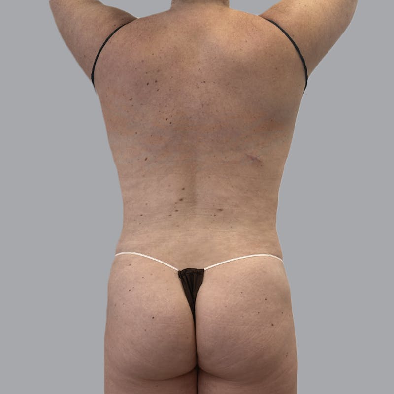 Body Liposuction Before & After Gallery - Patient 217186 - Image 8