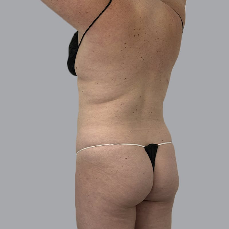 Body Liposuction Before & After Gallery - Patient 217186 - Image 5