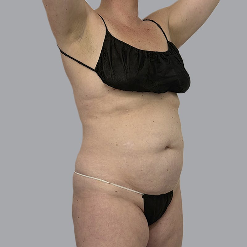 Body Liposuction Before & After Gallery - Patient 217186 - Image 3