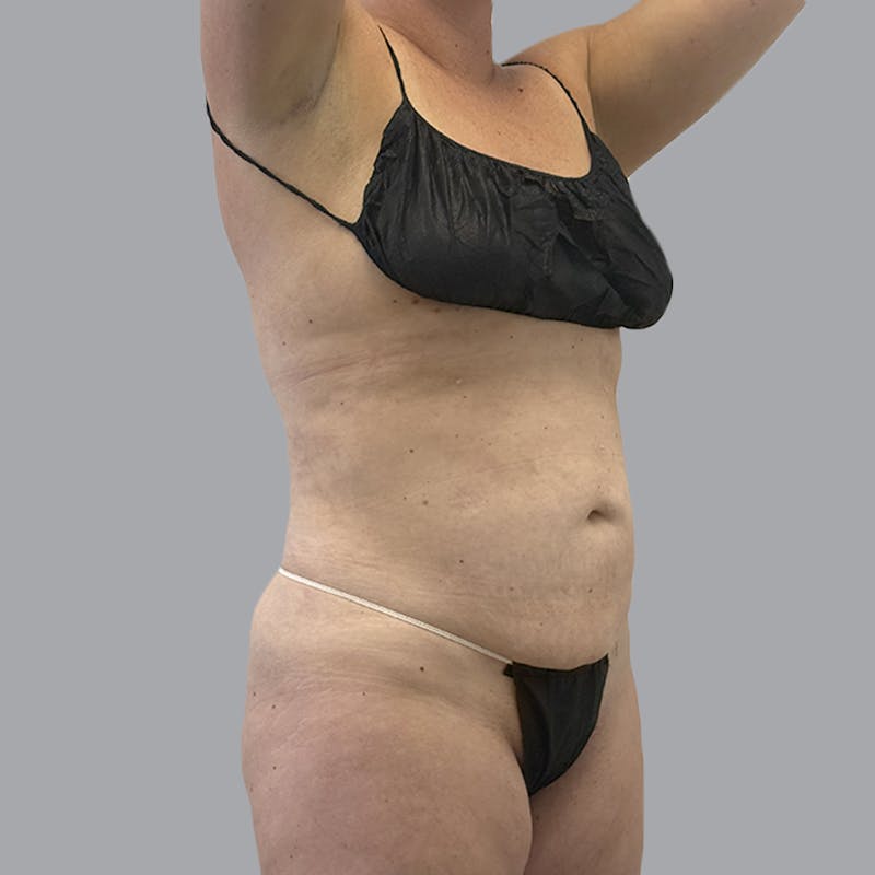 Body Liposuction Before & After Gallery - Patient 217186 - Image 4