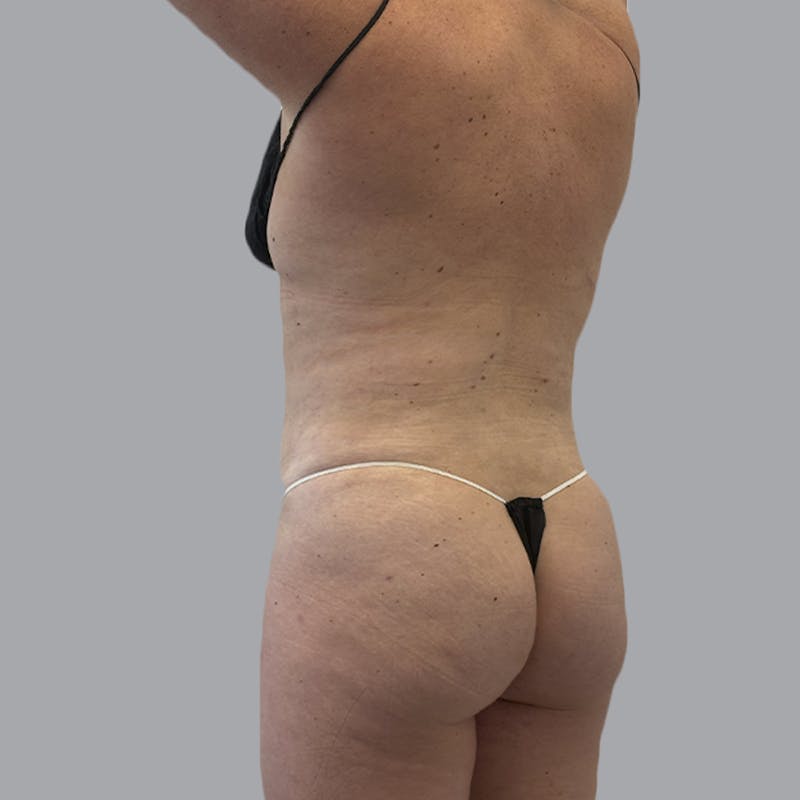 Body Liposuction Before & After Gallery - Patient 217186 - Image 6
