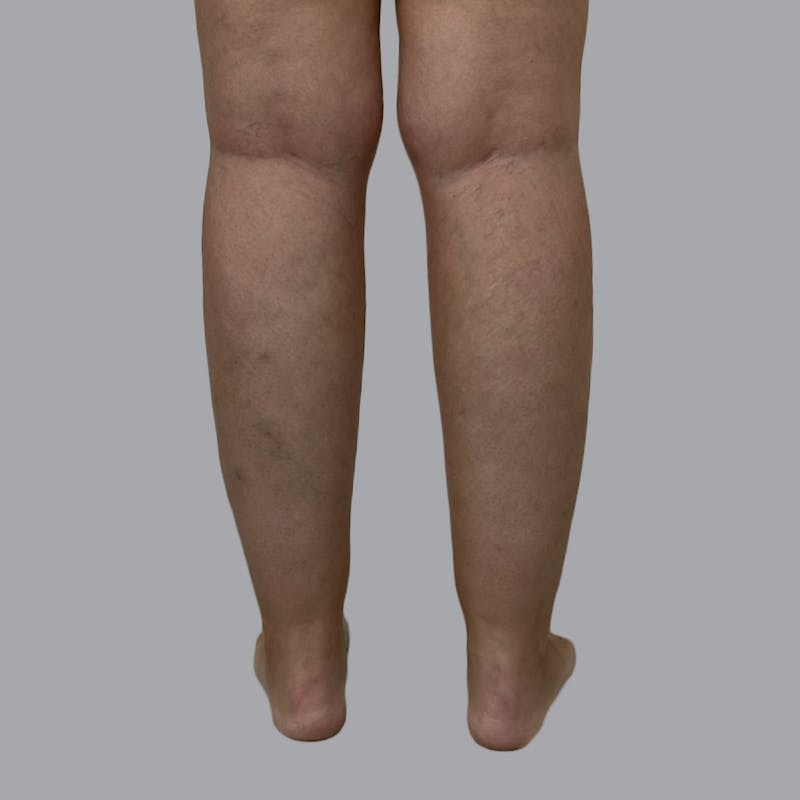 Leg Liposuction Before & After Gallery - Patient 342772 - Image 3