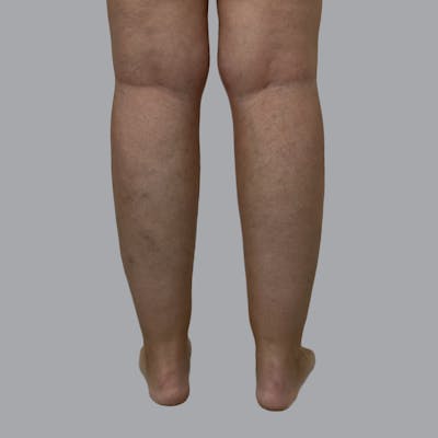 Lipedema Before & After Gallery - Patient 664870 - Image 3