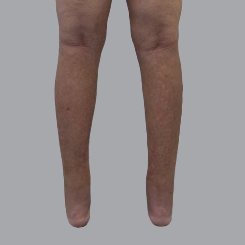 Leg Liposuction Before & After Gallery - Patient 342772 - Image 4