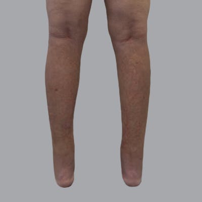 Lipedema Before & After Gallery - Patient 664870 - Image 4