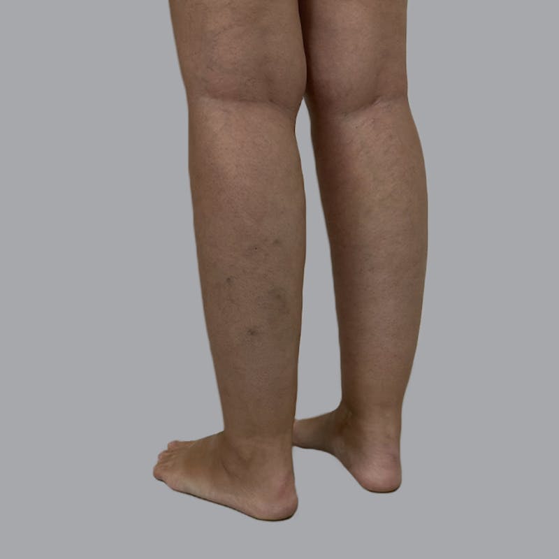 Leg Liposuction Before & After Gallery - Patient 342772 - Image 7