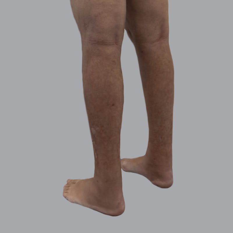 Leg Liposuction Before & After Gallery - Patient 342772 - Image 8