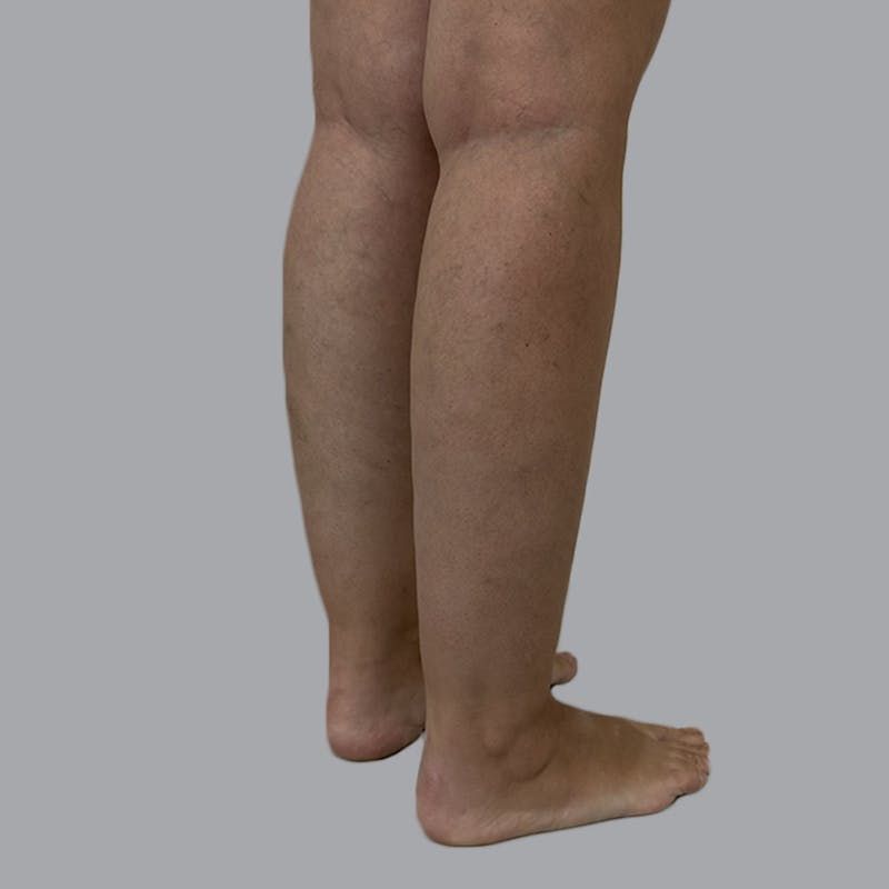 Leg Liposuction Before & After Gallery - Patient 342772 - Image 5