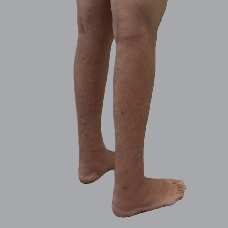 Leg Liposuction Before & After Gallery - Patient 342772 - Image 6